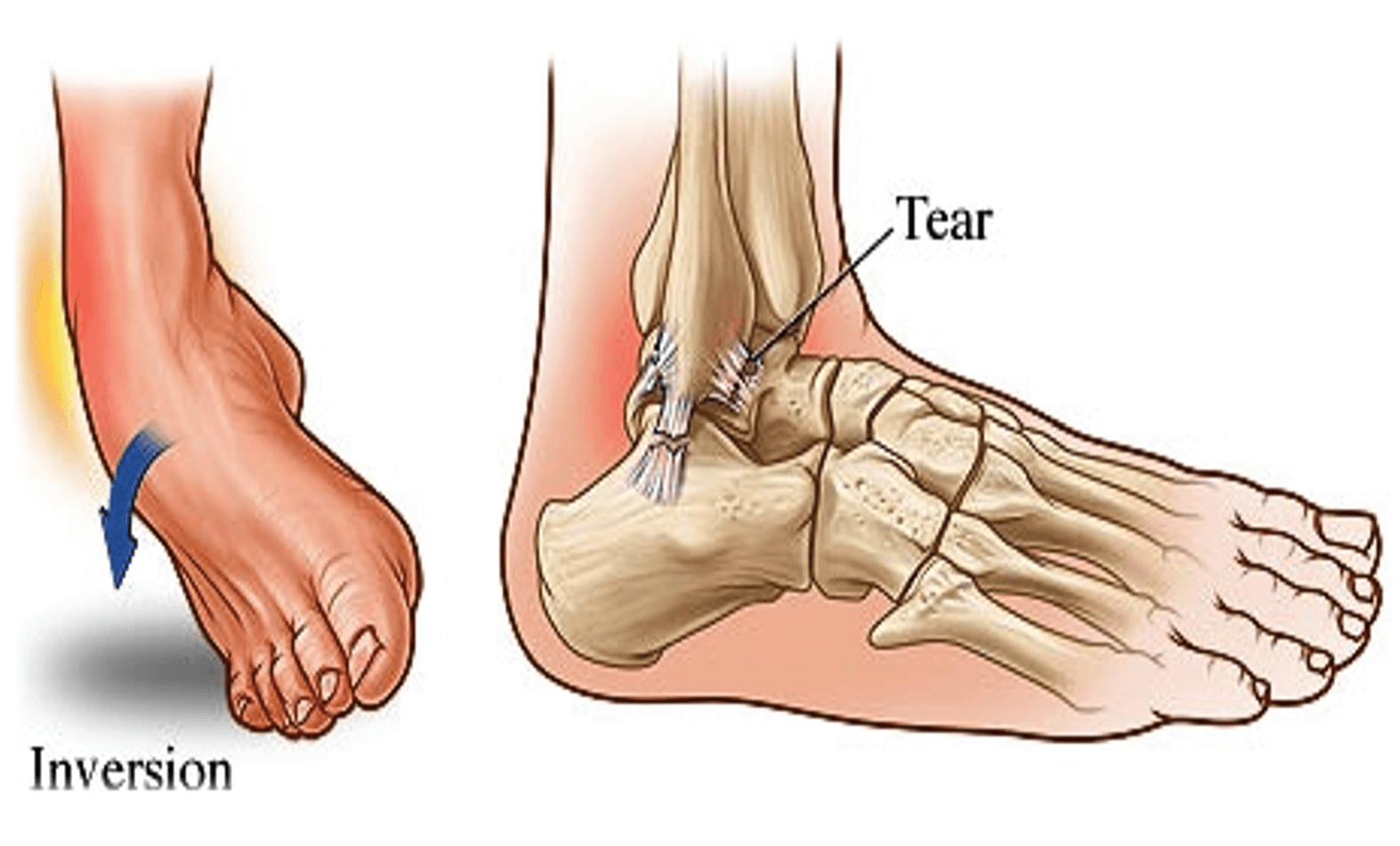 ankle sprain diagram.
