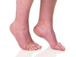 Image of a person who has ankle equinus