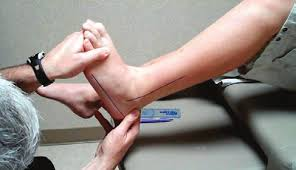 person with ankle equinus having foot assessed.