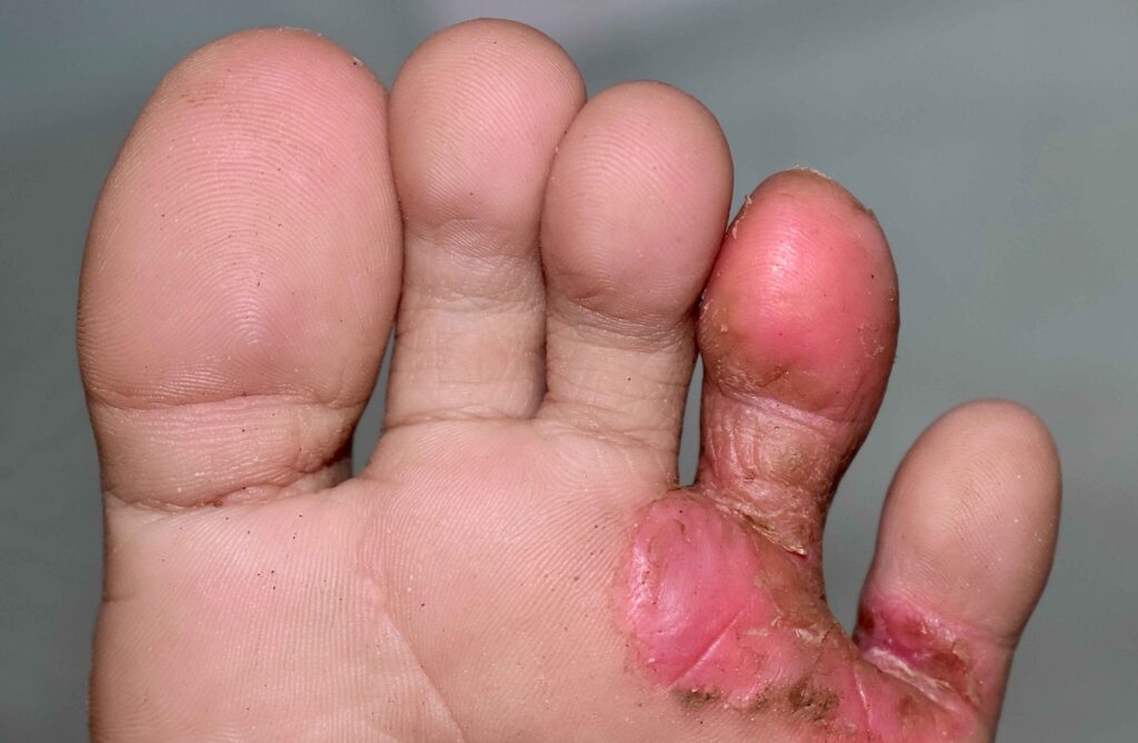 Tinea Pedis: The Annoying Fungus on your Feet