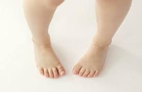 child's feet intoeing.