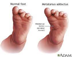 diagram of foot with metatarsus abductus